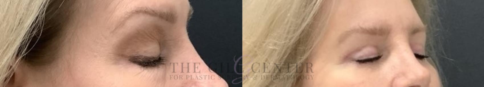 Eyelid Lift Case 705 Before & After Right side with eyes closed  | The Woodlands, TX | The Gill Center for Plastic Surgery and Dermatology