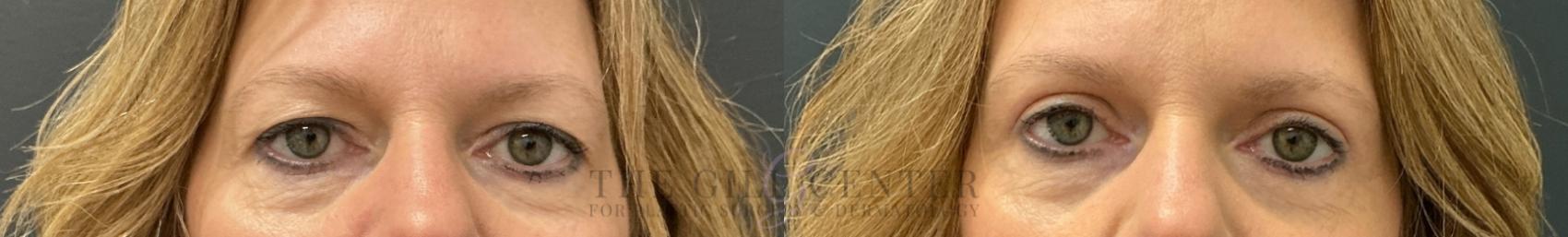 Eyelid Lift Case 763 Before & After Front | The Woodlands, TX | The Gill Center for Plastic Surgery and Dermatology