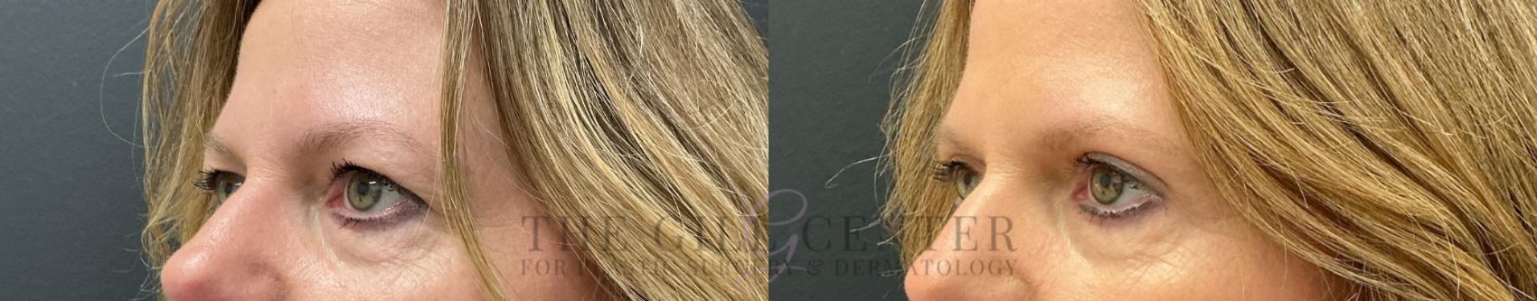 Eyelid Lift Case 763 Before & After Left Oblique | The Woodlands, TX | The Gill Center for Plastic Surgery and Dermatology