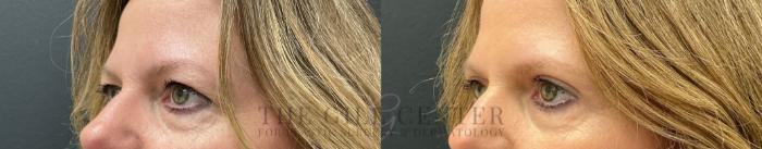 Eyelid Lift Case 763 Before & After Left Oblique | The Woodlands, TX | The Gill Center for Plastic Surgery and Dermatology