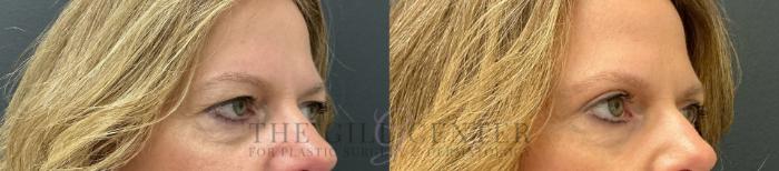 Eyelid Lift Case 763 Before & After Right Oblique | The Woodlands, TX | The Gill Center for Plastic Surgery and Dermatology