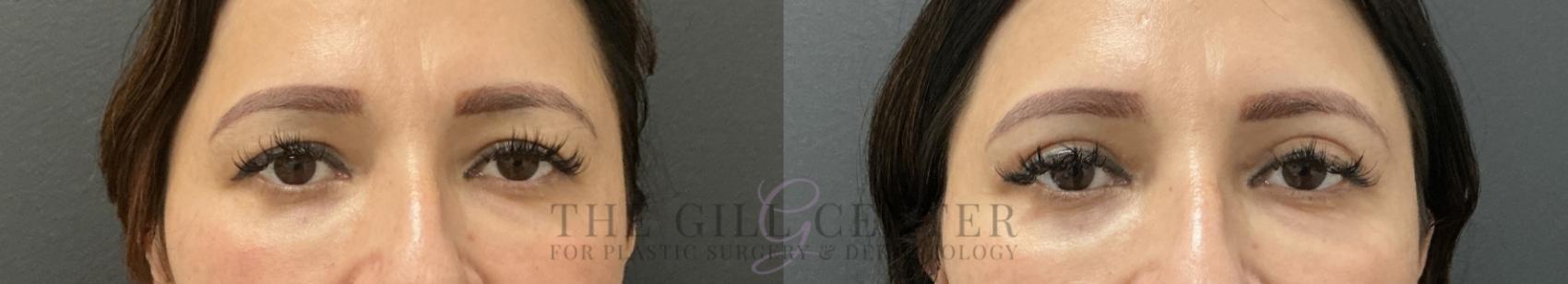 Eyelid Lift Case 766 Before & After Front | The Woodlands, TX | The Gill Center for Plastic Surgery and Dermatology