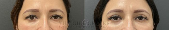 Eyelid Lift Case 766 Before & After Front | The Woodlands, TX | The Gill Center for Plastic Surgery and Dermatology