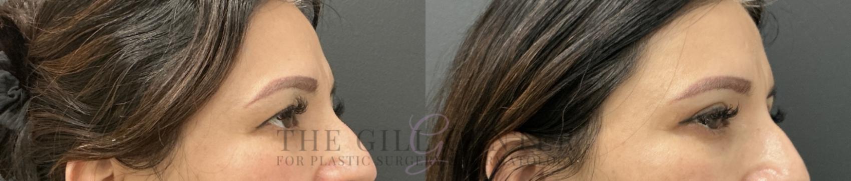 Eyelid Lift Case 766 Before & After Right Oblique | The Woodlands, TX | The Gill Center for Plastic Surgery and Dermatology