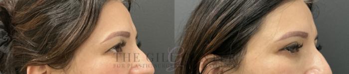 Eyelid Lift Case 766 Before & After Right Oblique | The Woodlands, TX | The Gill Center for Plastic Surgery and Dermatology