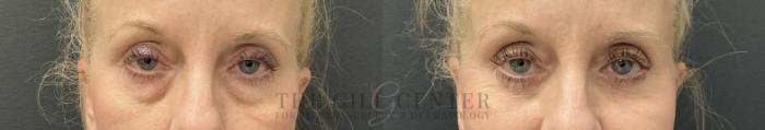 Eyelid Lift Case 781 Before & After Front | The Woodlands, TX | The Gill Center for Plastic Surgery and Dermatology