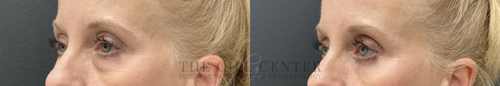 Eyelid Lift Case 781 Before & After Left Oblique | The Woodlands, TX | The Gill Center for Plastic Surgery and Dermatology