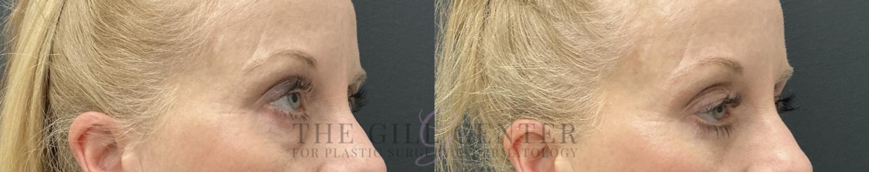 Eyelid Lift Case 781 Before & After Right Oblique | The Woodlands, TX | The Gill Center for Plastic Surgery and Dermatology