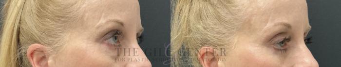 Eyelid Lift Case 781 Before & After Right Oblique | The Woodlands, TX | The Gill Center for Plastic Surgery and Dermatology