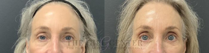 Eyelid Lift Case 784 Before & After Front | The Woodlands, TX | The Gill Center for Plastic Surgery and Dermatology