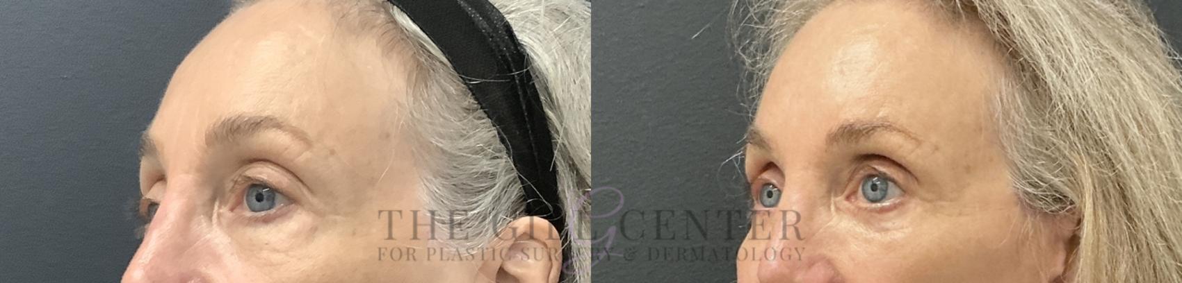 Eyelid Lift Case 784 Before & After Left Oblique | The Woodlands, TX | The Gill Center for Plastic Surgery and Dermatology
