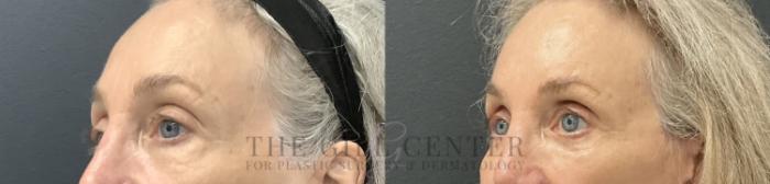 Eyelid Lift Case 784 Before & After Left Oblique | The Woodlands, TX | The Gill Center for Plastic Surgery and Dermatology