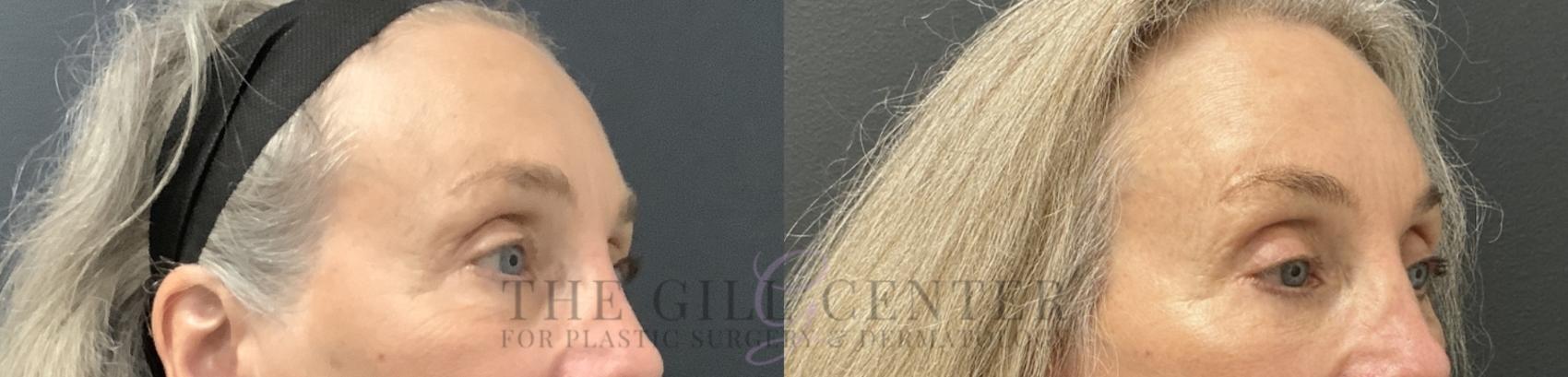 Eyelid Lift Case 784 Before & After Right Oblique | The Woodlands, TX | The Gill Center for Plastic Surgery and Dermatology