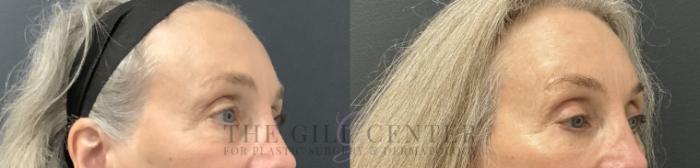 Eyelid Lift Case 784 Before & After Right Oblique | The Woodlands, TX | The Gill Center for Plastic Surgery and Dermatology