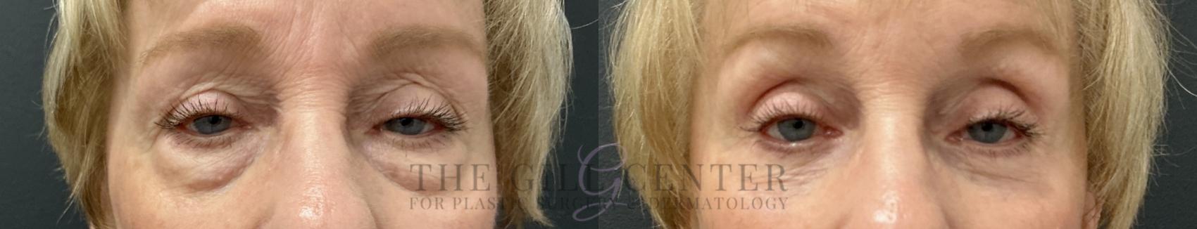 Eyelid Lift Case 789 Before & After Front | The Woodlands, TX | The Gill Center for Plastic Surgery and Dermatology