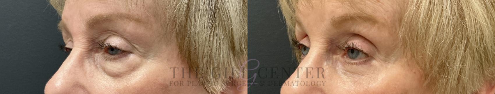 Eyelid Lift Case 789 Before & After Left Oblique | The Woodlands, TX | The Gill Center for Plastic Surgery and Dermatology