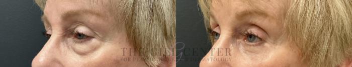 Eyelid Lift Case 789 Before & After Left Oblique | The Woodlands, TX | The Gill Center for Plastic Surgery and Dermatology