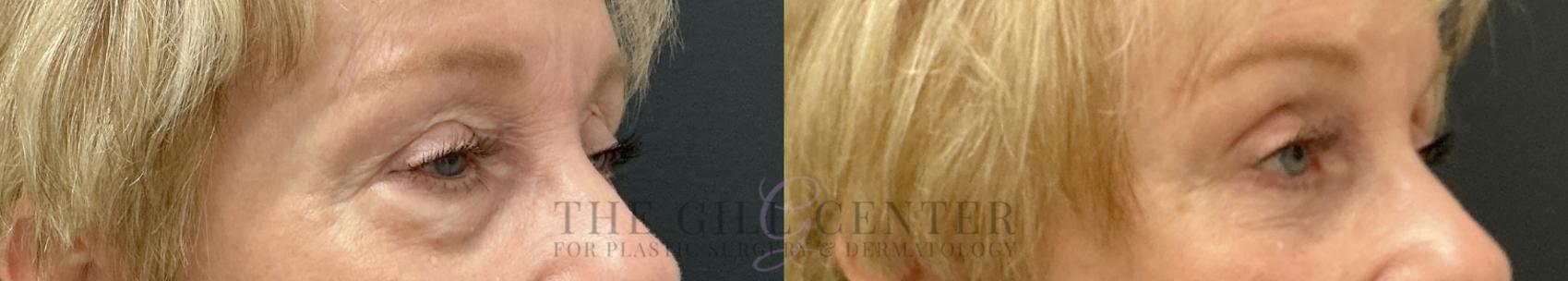 Eyelid Lift Case 789 Before & After Right Oblique | The Woodlands, TX | The Gill Center for Plastic Surgery and Dermatology