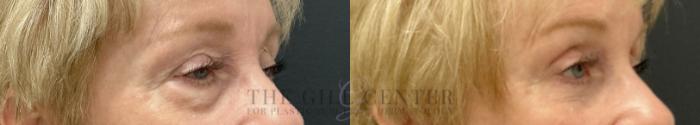 Eyelid Lift Case 789 Before & After Right Oblique | The Woodlands, TX | The Gill Center for Plastic Surgery and Dermatology