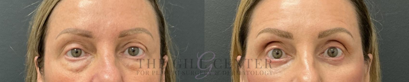 Eyelid Lift Case 801 Before & After Front | The Woodlands, TX | The Gill Center for Plastic Surgery and Dermatology