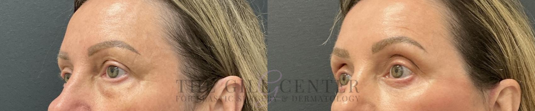 Eyelid Lift Case 801 Before & After Left Oblique | The Woodlands, TX | The Gill Center for Plastic Surgery and Dermatology