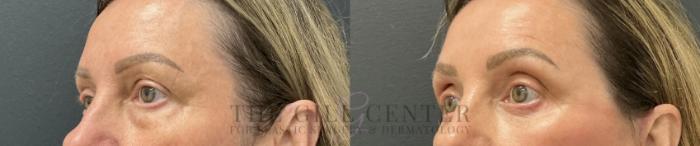 Eyelid Lift Case 801 Before & After Left Oblique | The Woodlands, TX | The Gill Center for Plastic Surgery and Dermatology