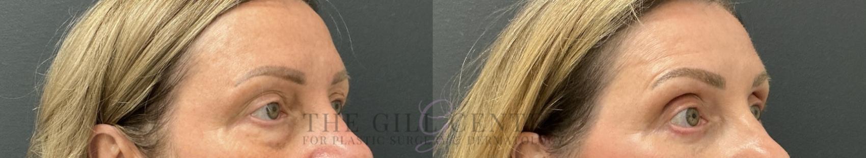 Eyelid Lift Case 801 Before & After Right Oblique | The Woodlands, TX | The Gill Center for Plastic Surgery and Dermatology
