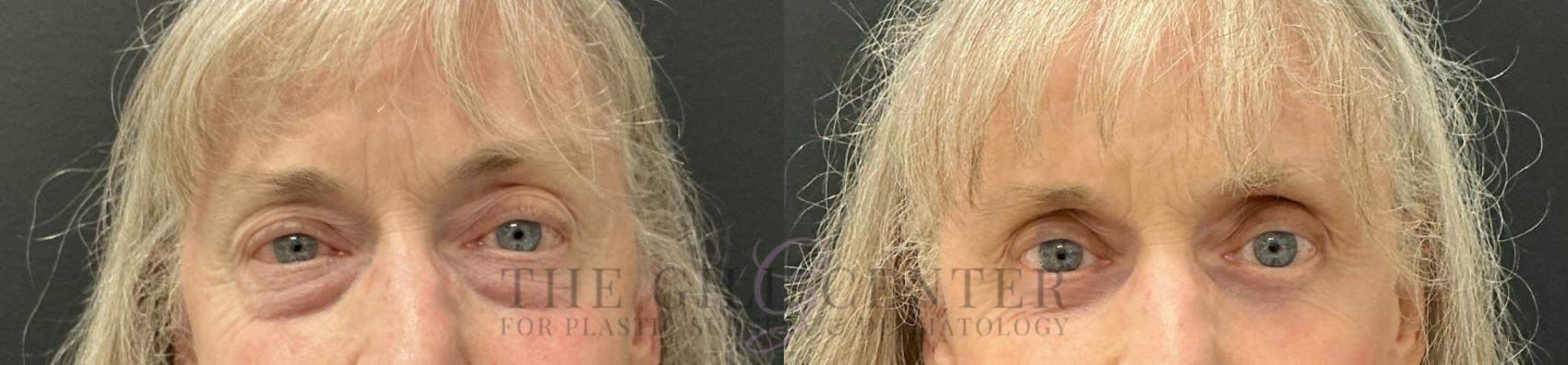 Eyelid Lift Case 812 Before & After Front | The Woodlands, TX | The Gill Center for Plastic Surgery and Dermatology