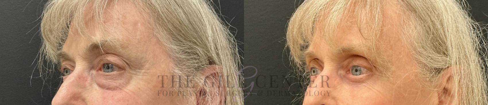 Eyelid Lift Case 812 Before & After Left Oblique | The Woodlands, TX | The Gill Center for Plastic Surgery and Dermatology