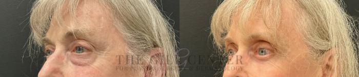 Eyelid Lift Case 812 Before & After Left Oblique | The Woodlands, TX | The Gill Center for Plastic Surgery and Dermatology