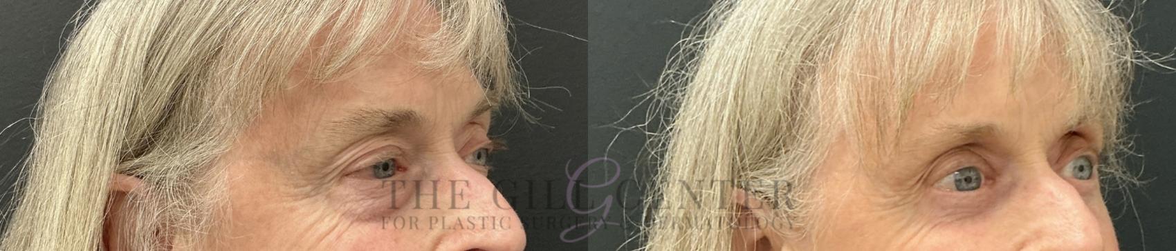 Eyelid Lift Case 812 Before & After Right Oblique | The Woodlands, TX | The Gill Center for Plastic Surgery and Dermatology