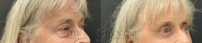 Eyelid Lift Case 812 Before & After Right Oblique | The Woodlands, TX | The Gill Center for Plastic Surgery and Dermatology