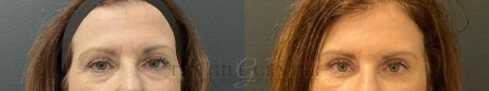 Eyelid Lift Case 818 Before & After Front | The Woodlands, TX | The Gill Center for Plastic Surgery and Dermatology