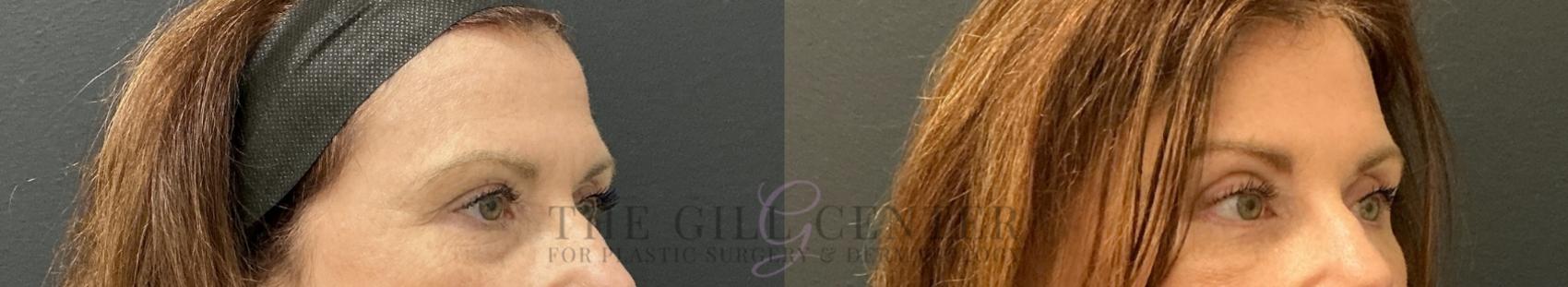 Eyelid Lift Case 818 Before & After Right Oblique | The Woodlands, TX | The Gill Center for Plastic Surgery and Dermatology