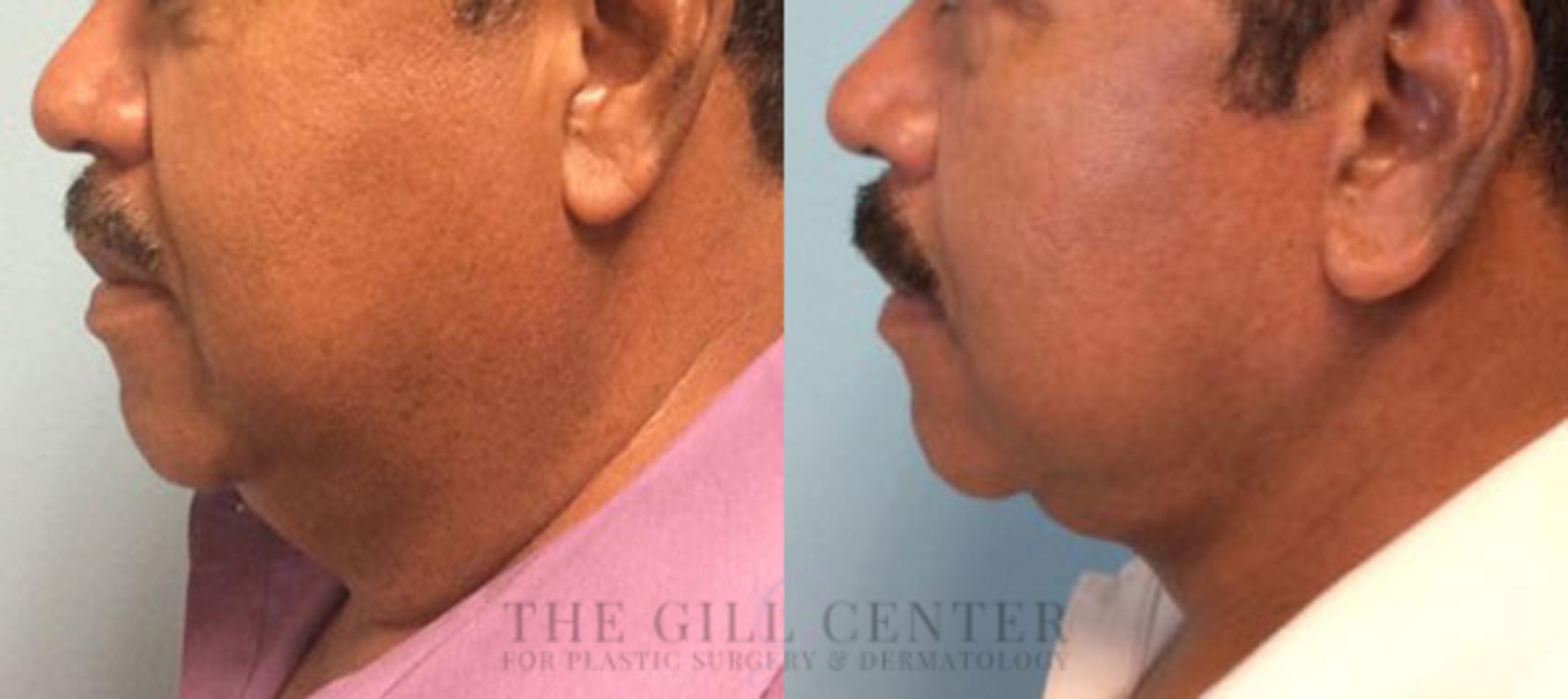 Face & Neck Lift Case 390 Before & After Left Side | The Woodlands, TX | The Gill Center for Plastic Surgery and Dermatology