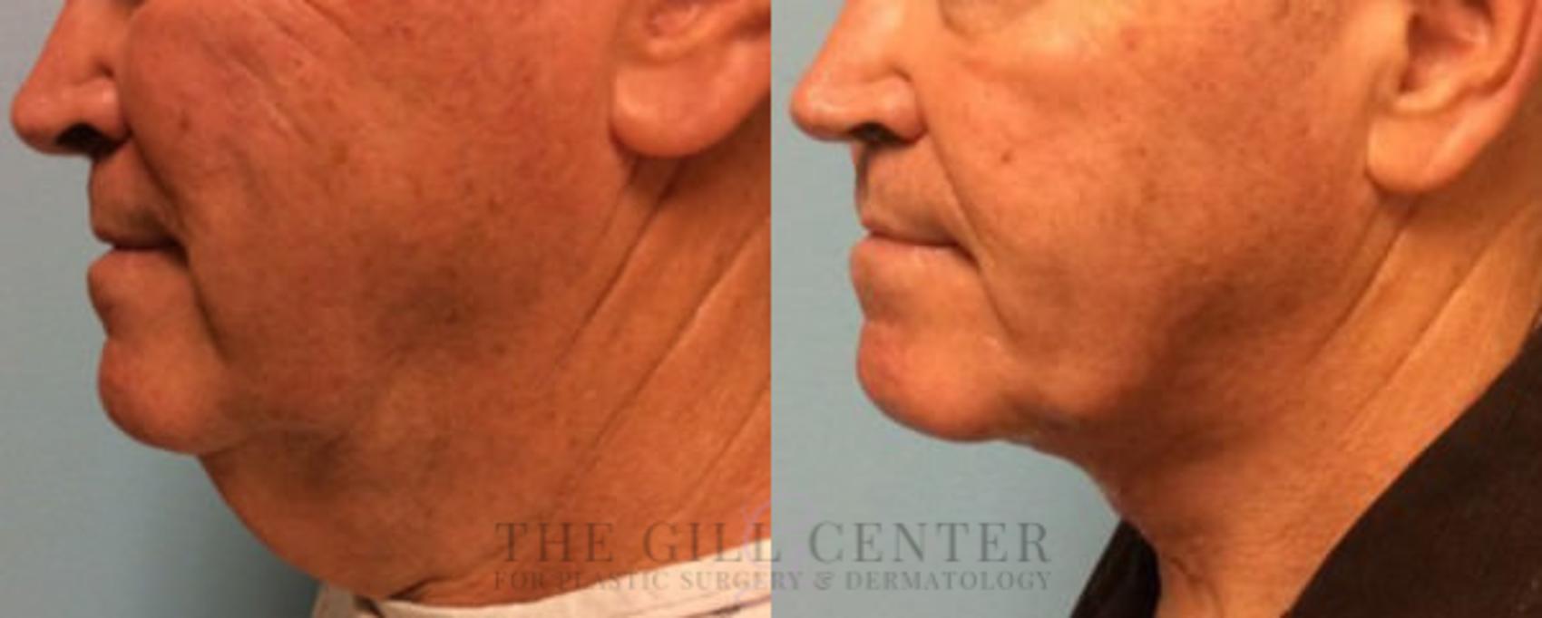 Face & Neck Lift Case 391 Before & After Left Side | The Woodlands, TX | The Gill Center for Plastic Surgery and Dermatology