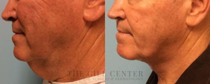 Face & Neck Lift Case 391 Before & After Left Side | The Woodlands, TX | The Gill Center for Plastic Surgery and Dermatology