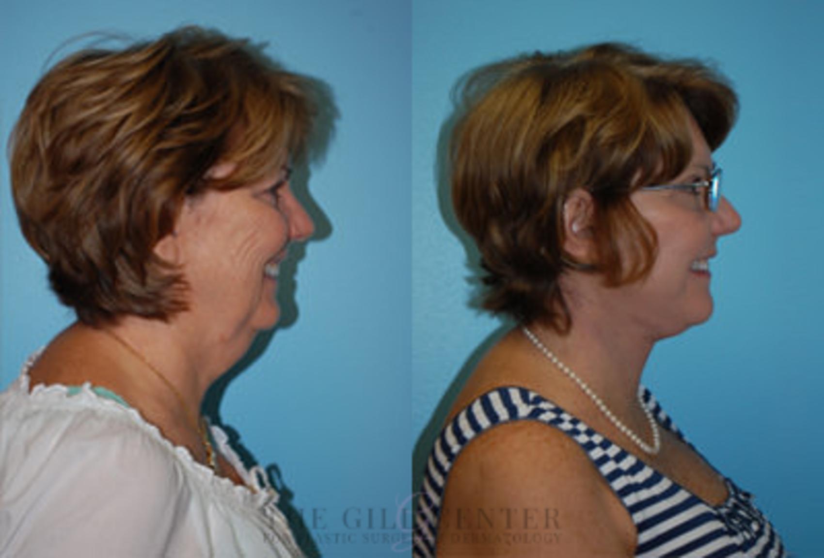 Face & Neck Lift Case 392 Before & After Right Side | The Woodlands, TX | The Gill Center for Plastic Surgery and Dermatology