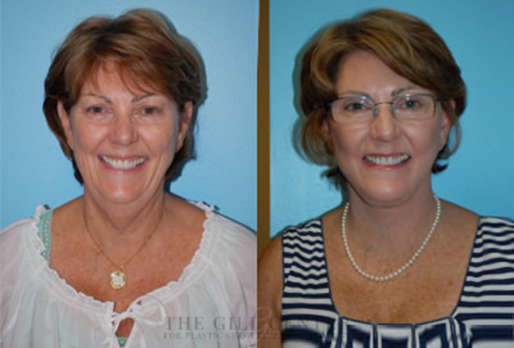 Face & Neck Lift Case 393 Before & After Front | The Woodlands, TX | The Gill Center for Plastic Surgery and Dermatology