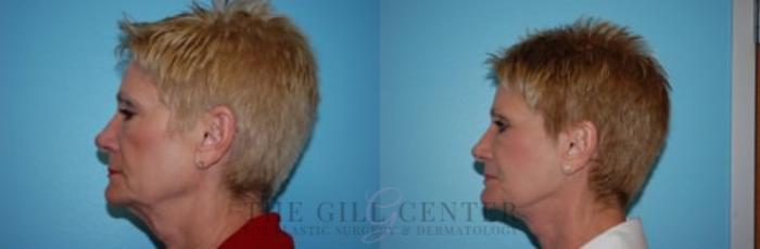 Face & Neck Lift Case 394 Before & After Left Side | The Woodlands, TX | The Gill Center for Plastic Surgery and Dermatology