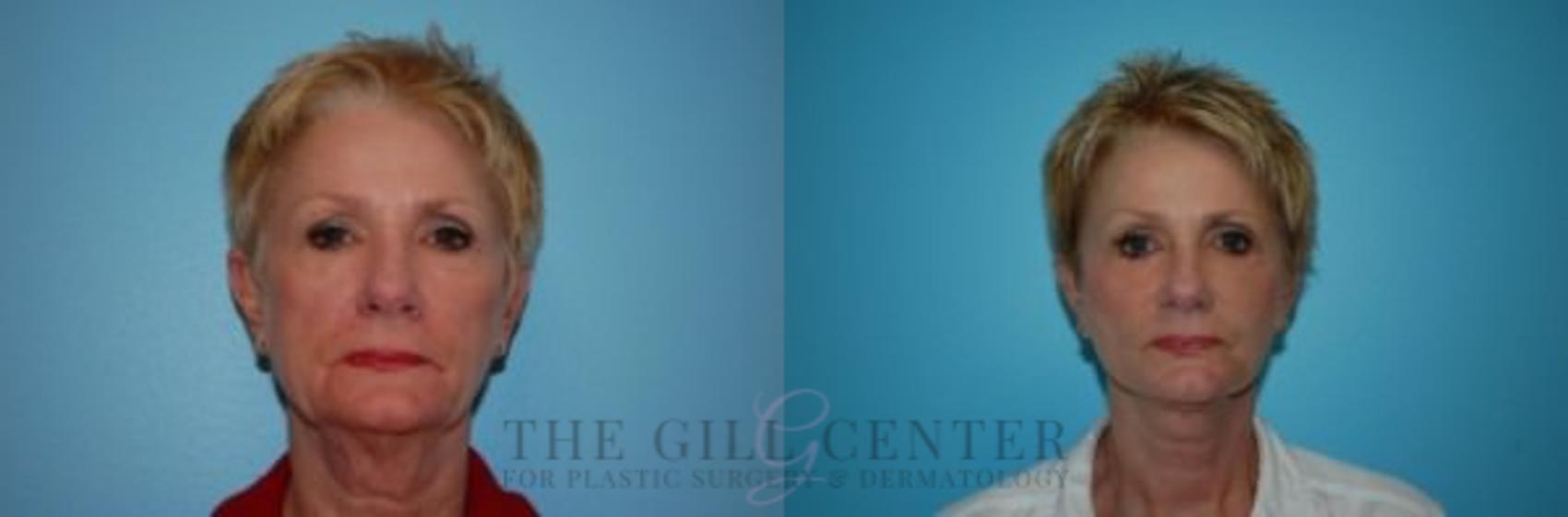 Face & Neck Lift Case 395 Before & After Front | The Woodlands, TX | The Gill Center for Plastic Surgery and Dermatology