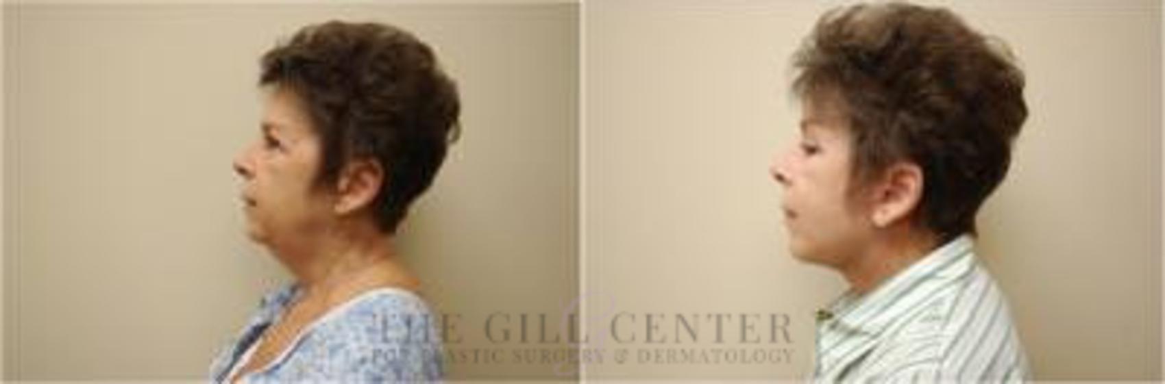 Face & Neck Lift Case 396 Before & After Left Side | The Woodlands, TX | The Gill Center for Plastic Surgery and Dermatology