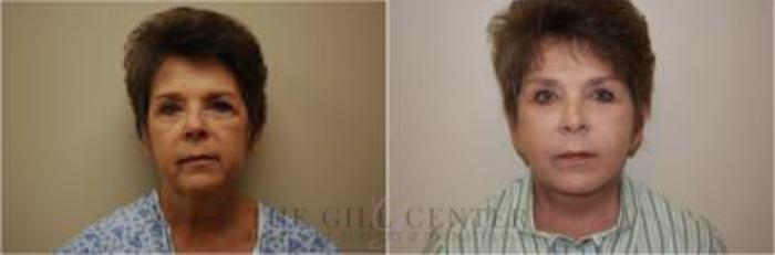 Face & Neck Lift Case 397 Before & After Front | The Woodlands, TX | The Gill Center for Plastic Surgery and Dermatology