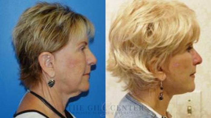 Face & Neck Lift Case 398 Before & After Right Side | The Woodlands, TX | The Gill Center for Plastic Surgery and Dermatology