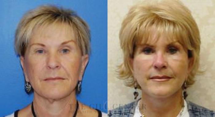 Face & Neck Lift Case 399 Before & After Front | The Woodlands, TX | The Gill Center for Plastic Surgery and Dermatology