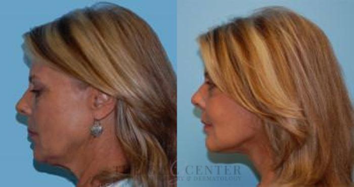 Face & Neck Lift Case 400 Before & After Left Side | The Woodlands, TX | The Gill Center for Plastic Surgery and Dermatology