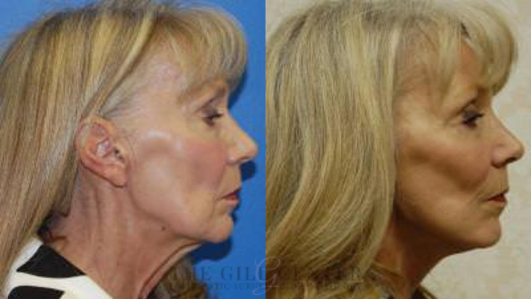 Face & Neck Lift Case 402 Before & After Right Side | The Woodlands, TX | The Gill Center for Plastic Surgery and Dermatology