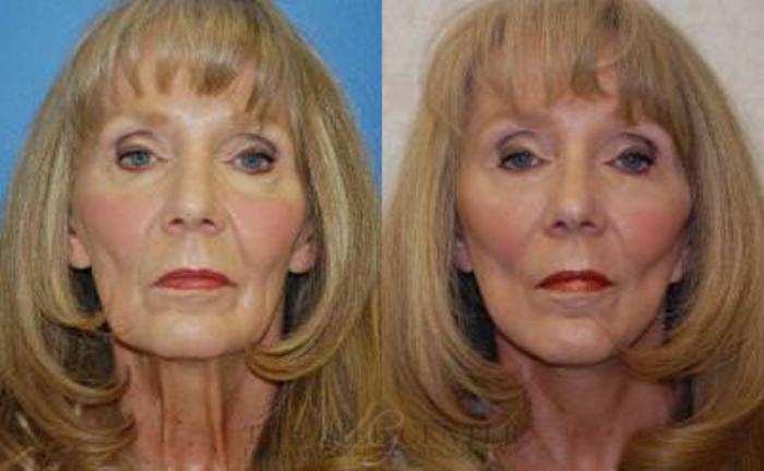 Face & Neck Lift Case 403 Before & After Front | The Woodlands, TX | The Gill Center for Plastic Surgery and Dermatology