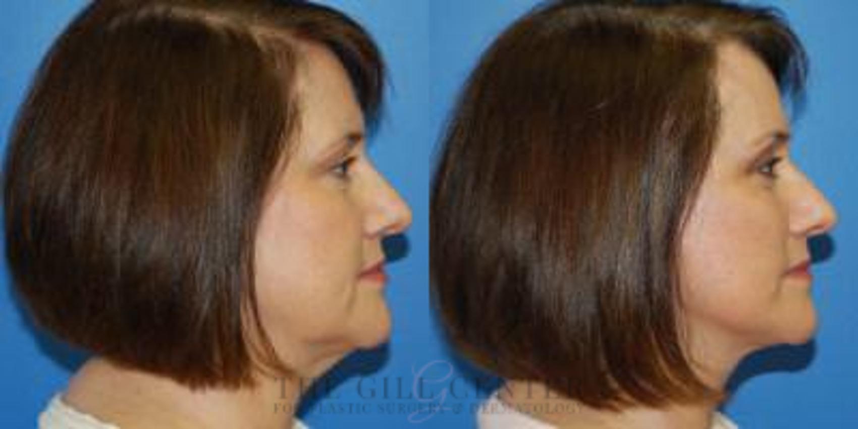Face & Neck Lift Case 404 Before & After Right Side | The Woodlands, TX | The Gill Center for Plastic Surgery and Dermatology
