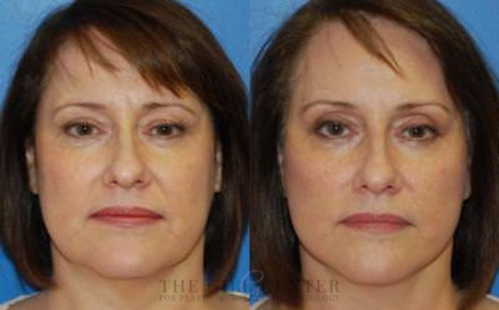 Face & Neck Lift Case 405 Before & After Front | The Woodlands, TX | The Gill Center for Plastic Surgery and Dermatology